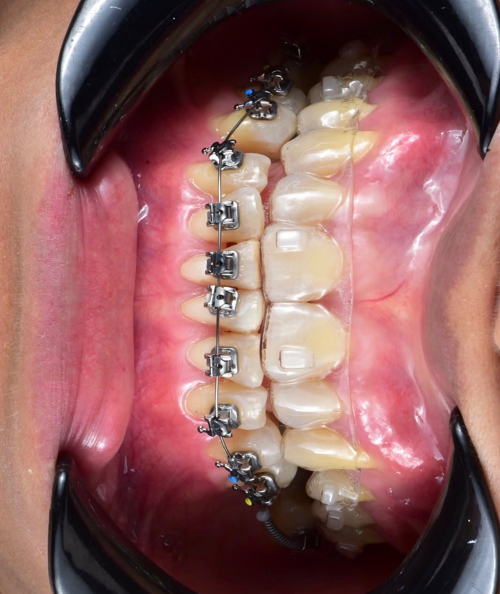Fotografía intraoral con brackets y alineador
