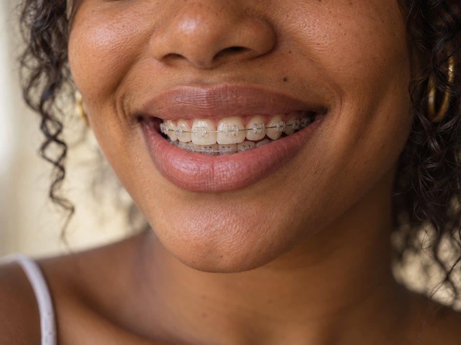 Sonrisa con brackets estéticos transparentes