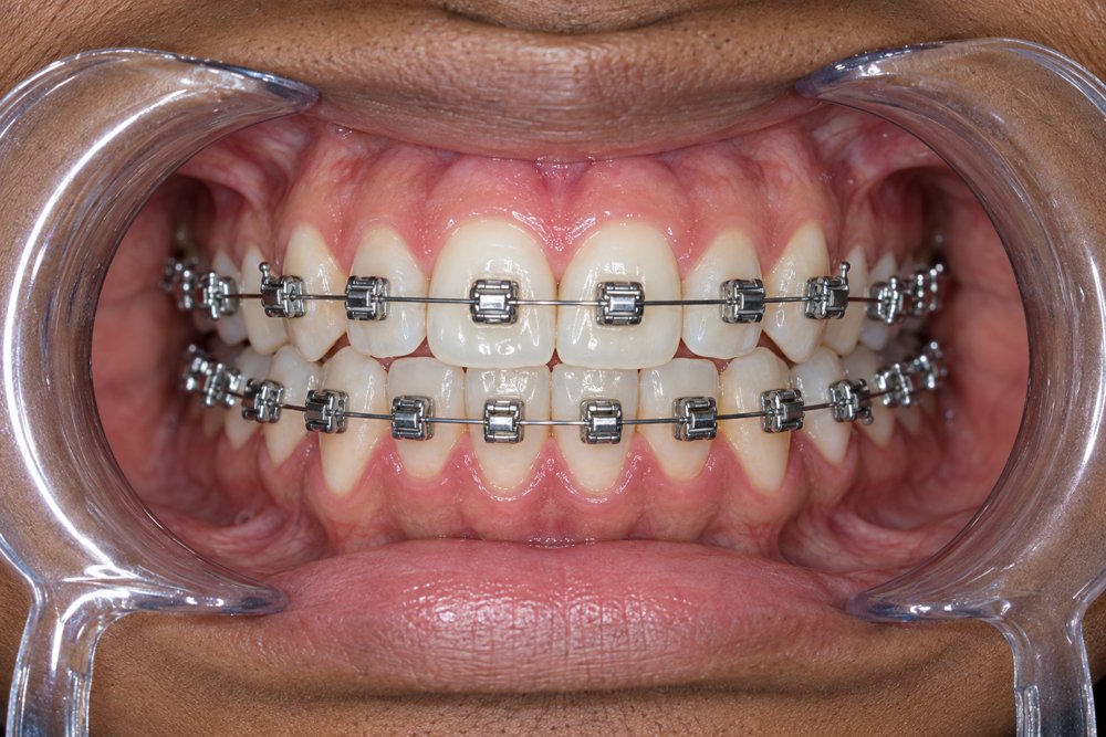Brackets metálicos de autoligado en vista frontal