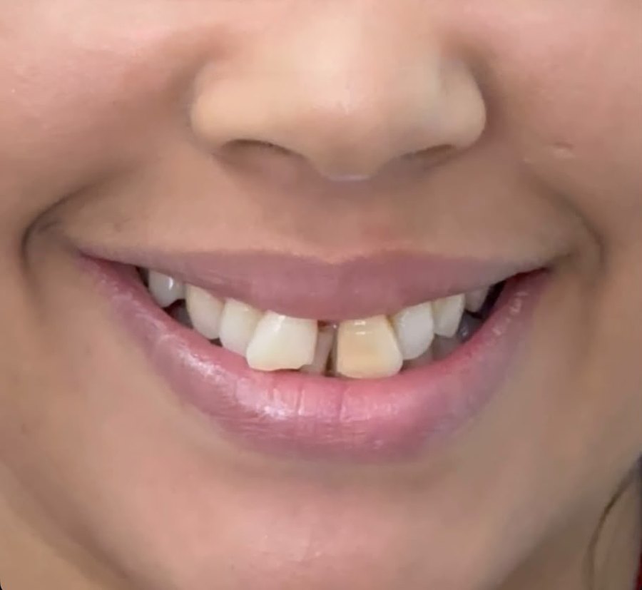 Caso A antes del tratamiento: dientes apiñados