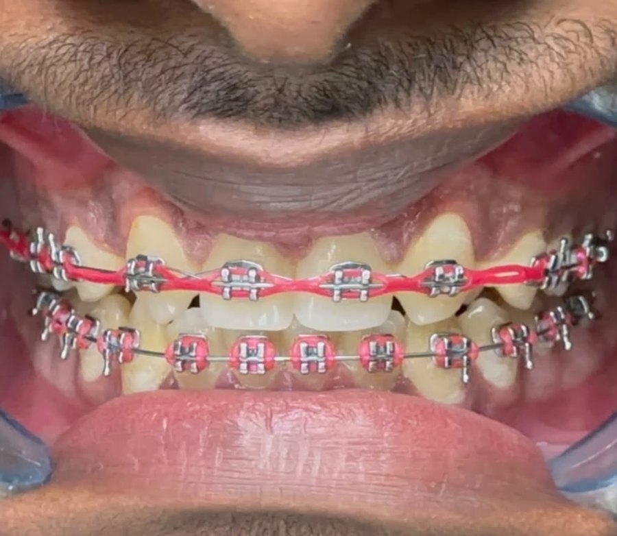 Caso B en tratamiento con brackets y ligas de color