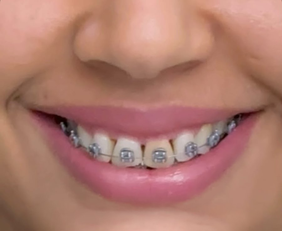 Caso A en tratamiento con brackets metálicos