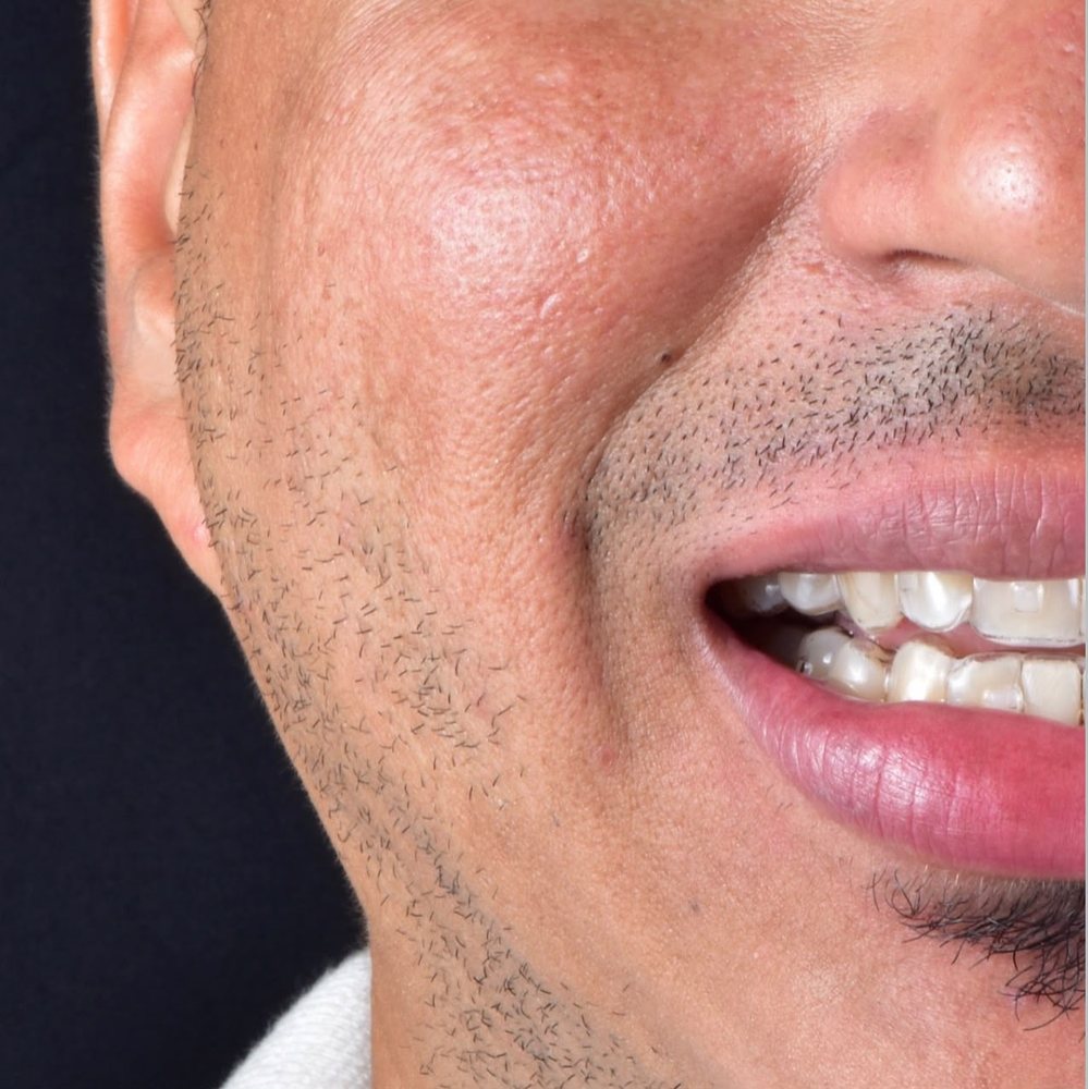 Sonrisa con alineadores, mitad izquierda del rostro