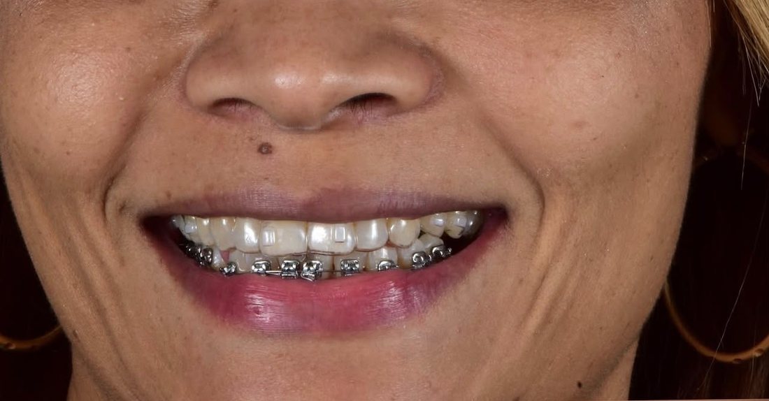 Sonrisa de paciente con brackets metálicos