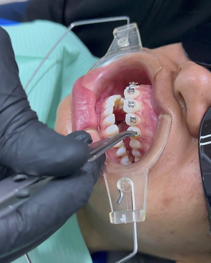 Colocación de brackets convencionales en consulta