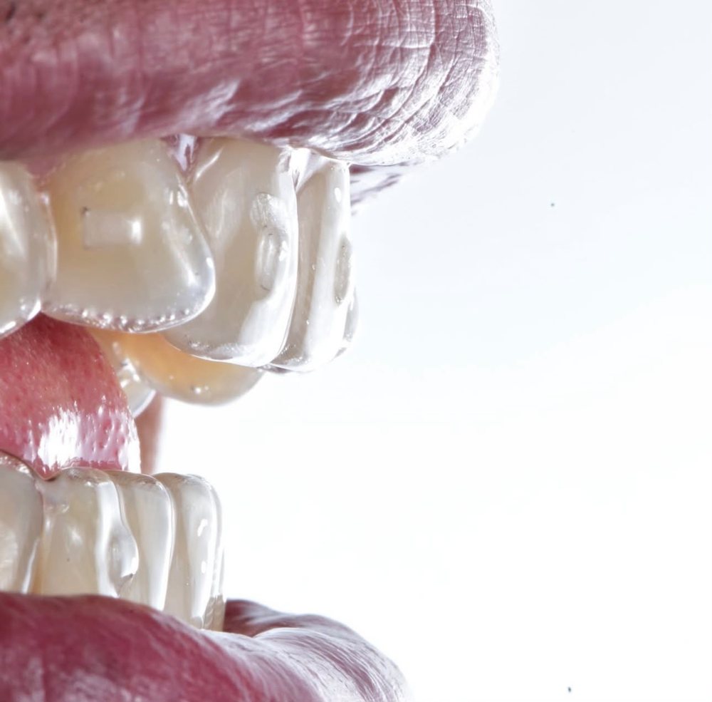 Detalle de alineador sobre los dientes